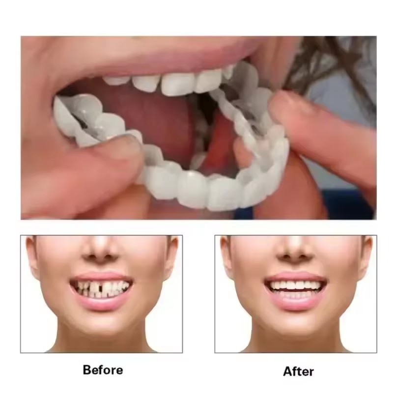 Teeth Veneers Whitening Dentur - огляд і ціна Teeth Whitening Session