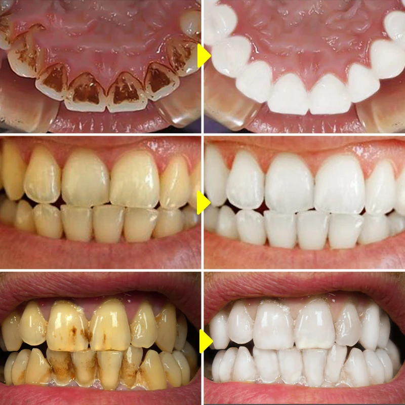 V34 Teeth Whitening Mousse Too - огляд і ціна Teeth Whitening Xylitol