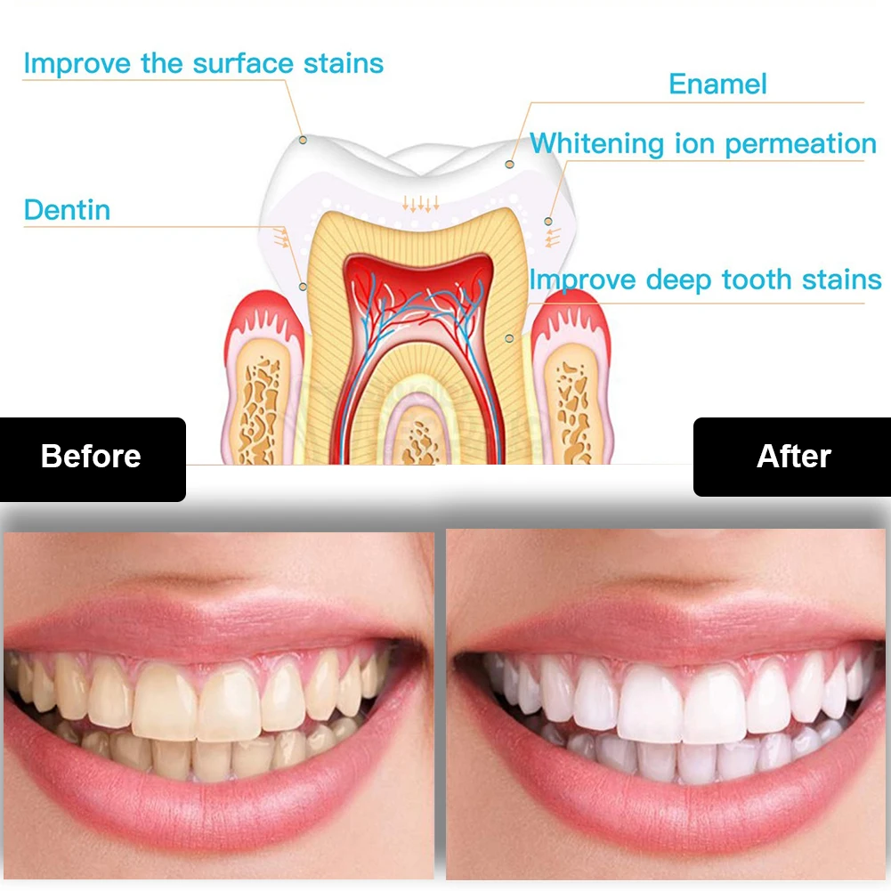 Dental Teeth Whitening Kit Min - огляд і ціна Teeth Whitening Gel